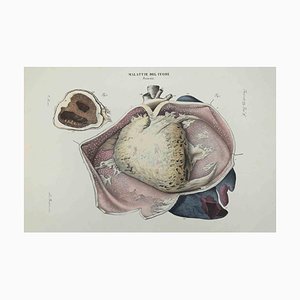 Ottavio Muzzi, Heart Disease, Lithograph, 1843