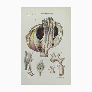 Ottavio Muzzi, Liver Disease, Lithograph, 1843