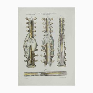 Ottavio Muzzi, Diseases of the Spinal Cord, Lithograph, 1843