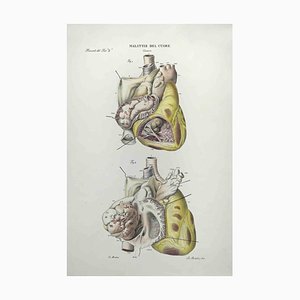 Ottavio Muzzi, Heart Disease, Lithograph, 1843
