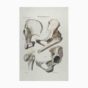Ottavio Muzzi, Bone Disease, Lithograph, 1843