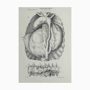 Ottavio Muzzi, Artery Disease, Lithograph, 1843
