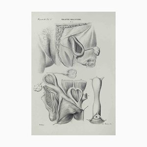 Ottavio Muzzi, Diseases of the Uterus, Lithograph, 1843
