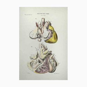Ottavio Muzzi, Heart Disease, Lithograph, 1843