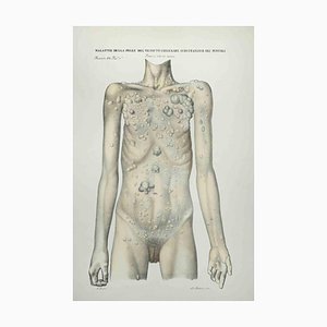 Ottavio Muzzi, Skin Diseases of Subcutaneous Cell Tissue and Muscles, Lithograph, 1843