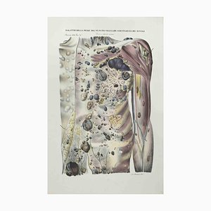 Ottavio Muzzi, Skin Diseases of Subcutaneous Cell Tissue and Muscles, Lithograph, 1843