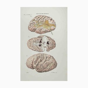 Ottavio Muzzi, Diseases of the Brain, Lithograph, 1843