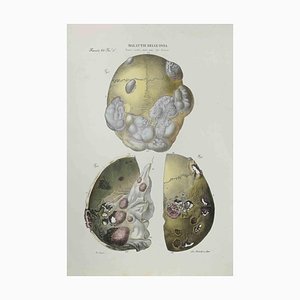 Ottavio Muzzi, Bone Disease, Lithograph, 1843