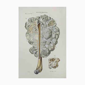 Ottavio Muzzi, Bone Disease, Lithograph, 1843