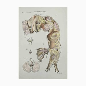 Ottavio Muzzi, Artery Disease, Lithograph, 1843