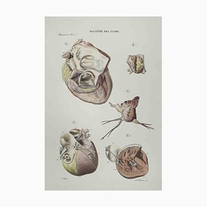 Ottavio Muzzi, Heart Disease, Lithograph, 1843