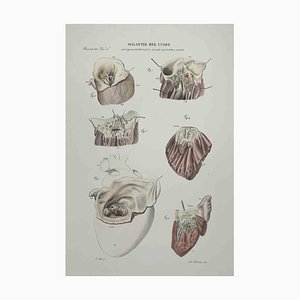 Ottavio Muzzi, Heart Disease, Lithograph, 1843