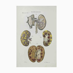 Ottavio Muzzi, Kidney Disease, Lithograph, 1843