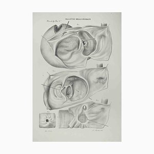 Ottavio Muzzi, Stomach Diseases, Lithograph, 1843