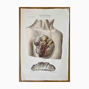 Ottavio Muzzi, Breast Diseases, Lithograph, 1843