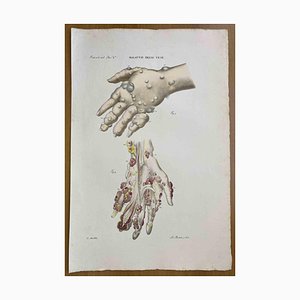 Ottavio Muzzi, Vein Diseases, Lithograph, 1843
