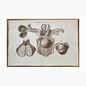 Ottavio Muzzi, Enfermedades del útero, Litografía, 1843