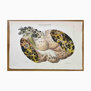 Ottavio Muzzi, Enfermedad del hígado, Litografía, 1843
