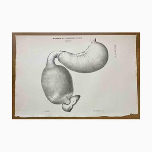 Ottavio Muzzi, Small Intestine Disease, Lithograph, 1843