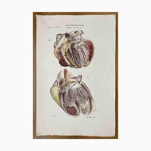 Ottavio Muzzi, Heart Diseases, Lithograph, 1843