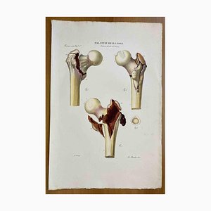 Ottavio Muzzi, Maladies des Os, Lithographie, 1843