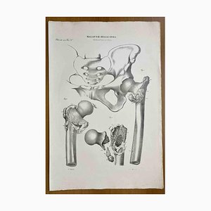 Ottavio Muzzi, Bone Diseases, Lithograph, 1843