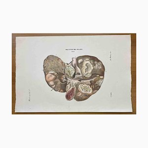 Ottavio Muzzi, Liver Disease, Lithograph, 1843