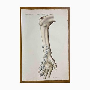 Ottavio Muzzi, Vein Diseases, Lithograph, 1843