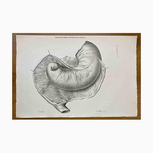 Ottavio Muzzi, Small Intestine Disease, Lithograph, 1843