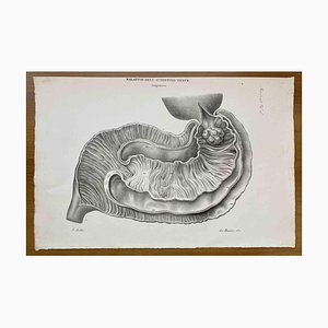 Ottavio Muzzi, Small Intestine Disease, Lithograph, 1843
