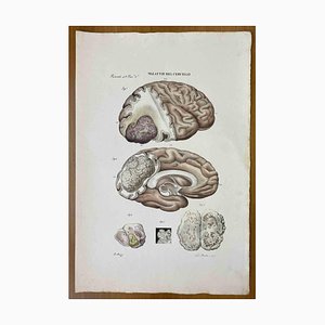 Ottavio Muzzi, Brain Disease, Lithograph, 1843