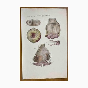 Ottavio Muzzi, Enfermedades intestinales, litografía, 1843
