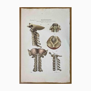 Ottavio Muzzi, Bone Diseases, Lithograph, 1843