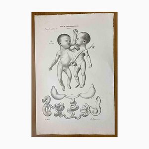Ottavio Muzzi, Défauts de Conformation, Lithographie, 1843