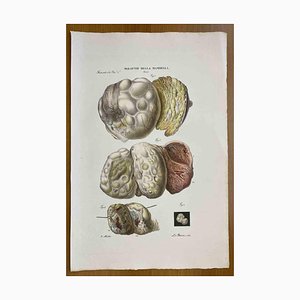 Ottavio Muzzi, Breast Diseases, Lithograph, 1843