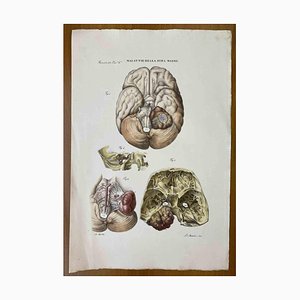 Ottavio Muzzi, Diseases of the Dura Mater, Lithograph, 1843
