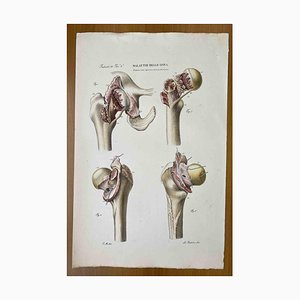 Ottavio Muzzi, Bone Diseases, Lithograph, 1843
