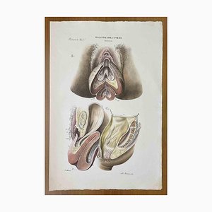 Ottavio Muzzi, Diseases of the Uterus, Lithograph, 1843