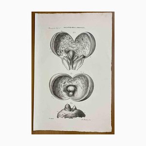 Ottavio Muzzi, Prostatakrankheiten, Lithographie, 1843