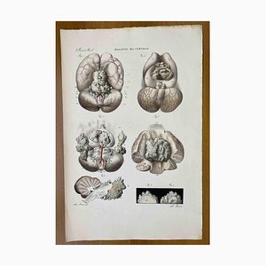 Ottavio Muzzi, Brain Diseases, Lithograph, 1843