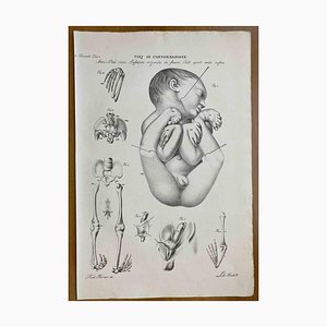 Ottavio Muzzi, Défauts de Conformation, Lithographie, 1843