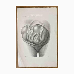 Ottavio Muzzi, Intestinal Diseases, Lithograph, 1843