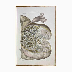 Ottavio Muzzi, Diseases of the Ovary, Lithograph, 1843