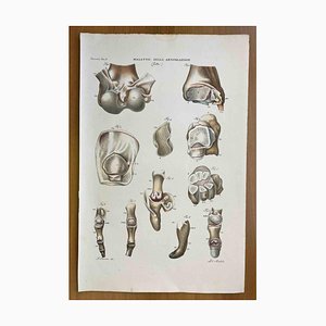 Ottavio Muzzi, Joint Diseases, Lithograph, 1843