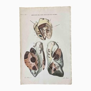 Ottavio Muzzi, Apoplexy of the Heart and Lungs, Lithograph, 1843