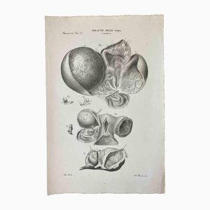 Ottavio Muzzi, Diseases of the Ovary, Lithograph, 1843