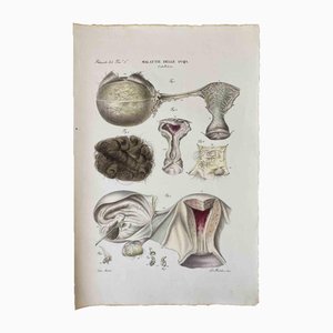 Ottavio Muzzi, Diseases of the Ovary, Lithograph, 1843