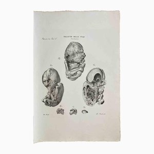 Ottavio Muzzi, Diseases of the Ovary, Lithograph, 1843
