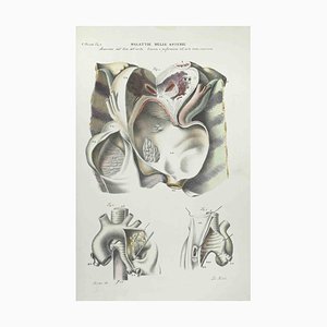 Ottavio Muzzi, Erkrankungen der Arterien, Lithographie, 1843