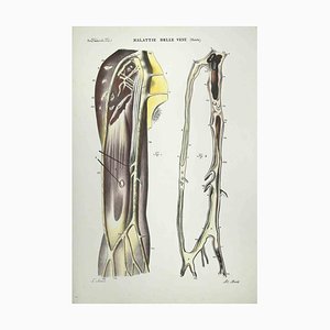 Ottavio Muzzi, Vein Diseases, Lithograph, 1843